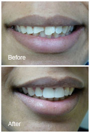 Couronnes Couronnes dentaires