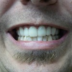 Lumineers After Lumineers Before & After