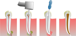 Endodontics: Root Canal Endodontics: Root Canal